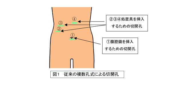 単孔式腹腔鏡下胆嚢摘出術 図1