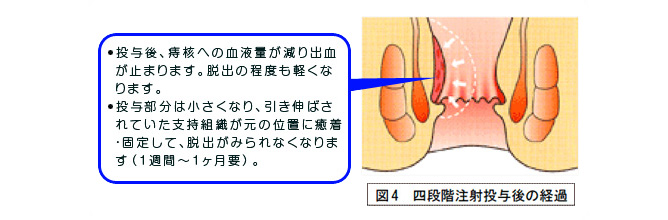 単孔式腹腔鏡下胆嚢摘出術 図1