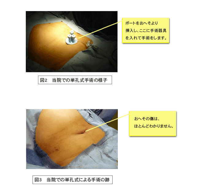 単孔式腹腔鏡下胆嚢摘出術 図2