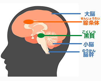 パーキンソン病