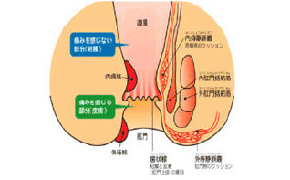 痔核（いぼ痔）