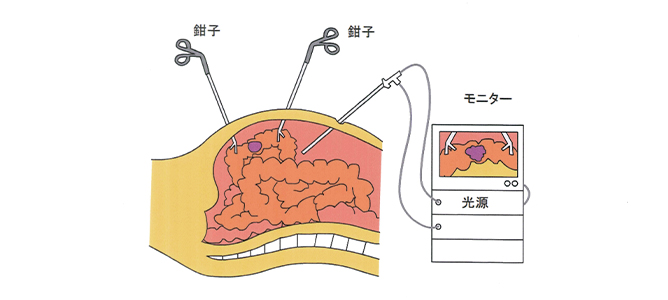 腹腔鏡下手術 図1